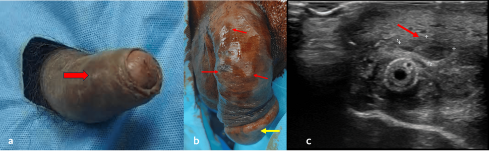A Patient Diagnosed With Priapism: Key Clinical Manifestations