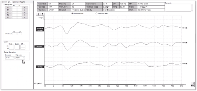 How Does Auditory Neuropathy Manifest in an ABR Test?