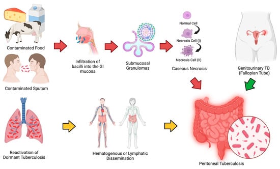 Which Clinical Manifestation Signals Tuberculosis Diagnosis?