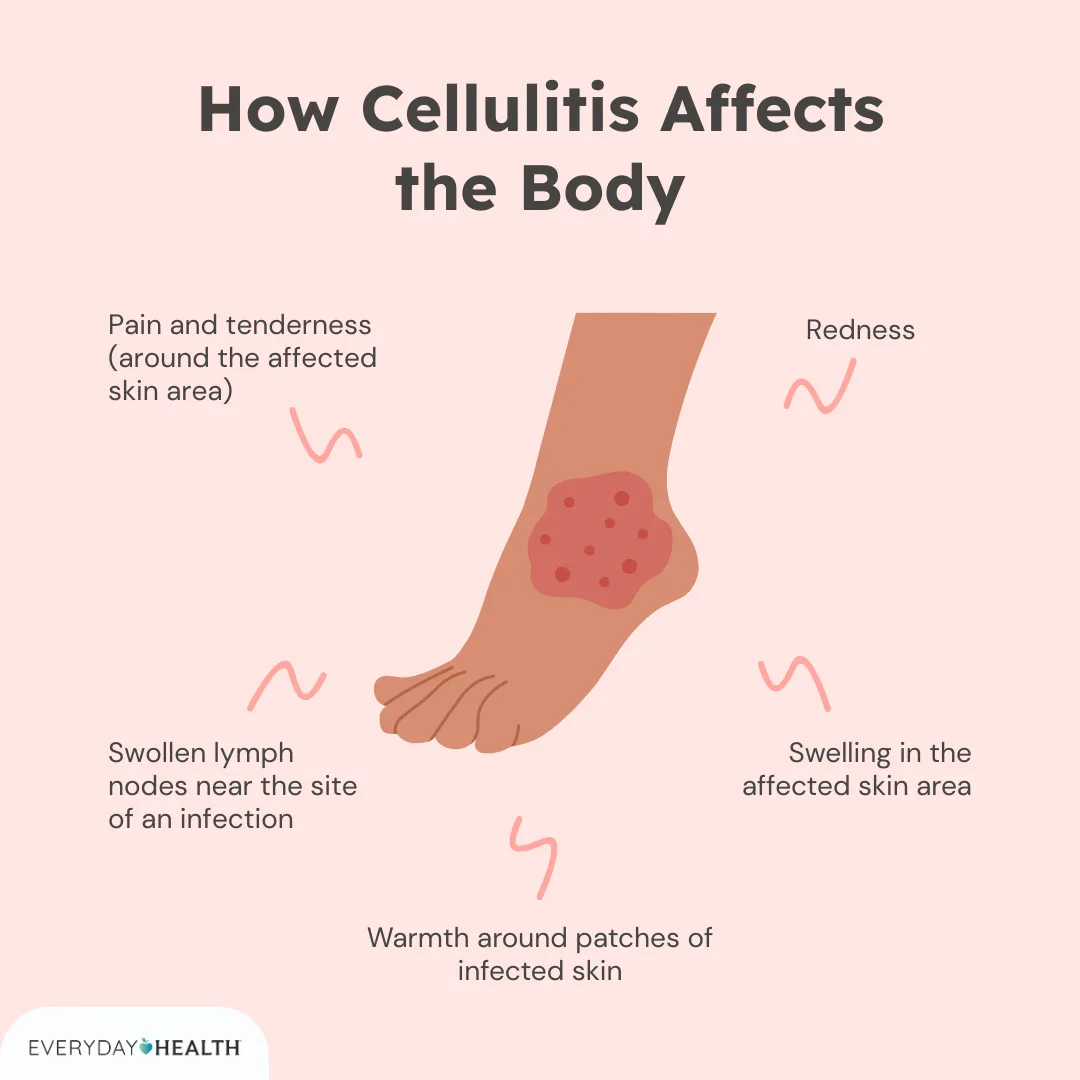 Which Clinical Manifestation is Associated With Cellulitis