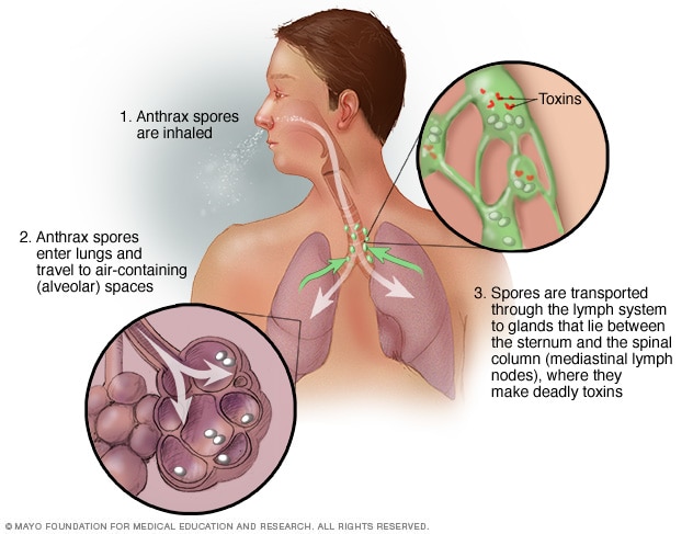 Which Clinical Manifestation is Associated With Inhalation Anthrax: Key Symptoms Explained