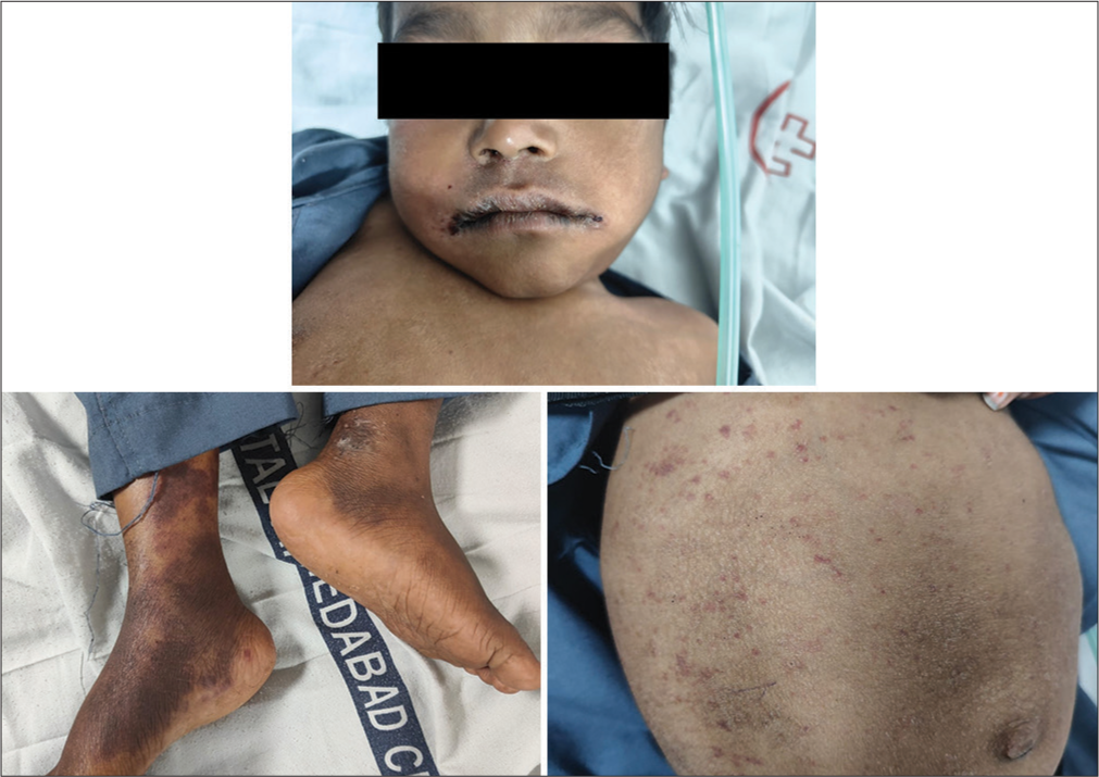 Which is a Major Manifestation of Wiskott-Aldrich Syndrome: Key Insights